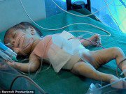 Làm mẹ - Chào đời với người anh em ký sinh dính liền bụng, bé trai 9 ngày tuổi được tách rời