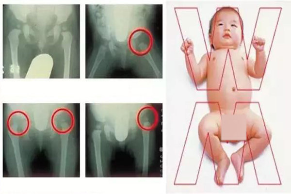 2 thói quen mà nhiều mẹ thường thích làm dễ khiến con trật khớp háng, khớp khuỷu tay - 2