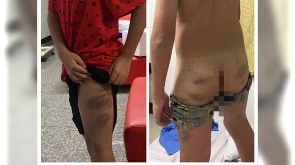 Bé trai lớp 5 bị mẹ đánh đập tàn nhẫn vì thi không đạt số điểm như mẹ yêu cầu - 2