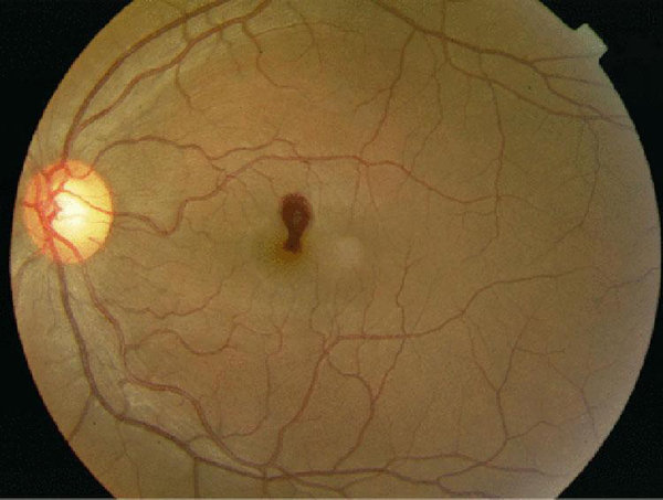 Sau đêm amp;#39;ân áiamp;#39; với bạn gái, chàng trai 29 tuổi bị xuất huyết mắt vì lý do bất ngờ - 1