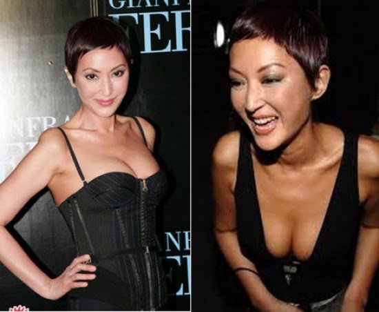 amp;#34;Thảm họa thẩm mỹamp;#34; Hong Kong gây bất ngờ vì mắc ung thư vú vẫn tiếp tục amp;#34;dao kéoamp;#34; - 5