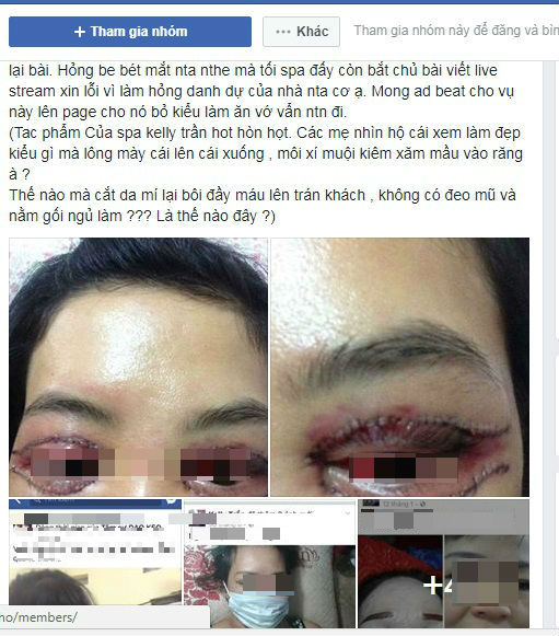 Hà Nội: Cô gái trẻ mắt thâm đen, mặt biến dạng sau khi đi làm mí ở spa - 1