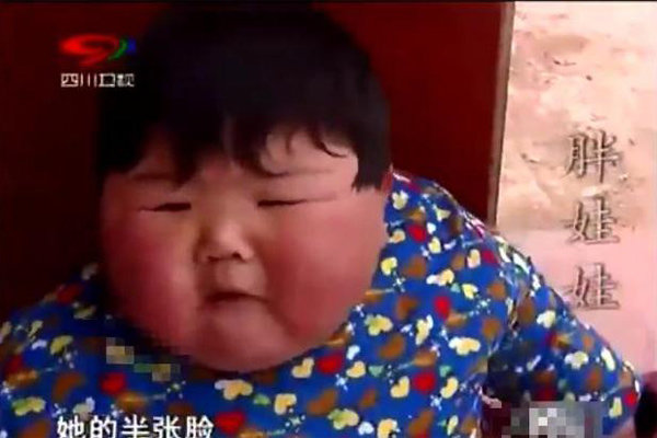 Mẹ chiều chuộng cho ăn uống thoải mái, bé 2 tuổi có cân nặng amp;#34;khủngamp;#34; gần 40kg, chân biến dạng - 4