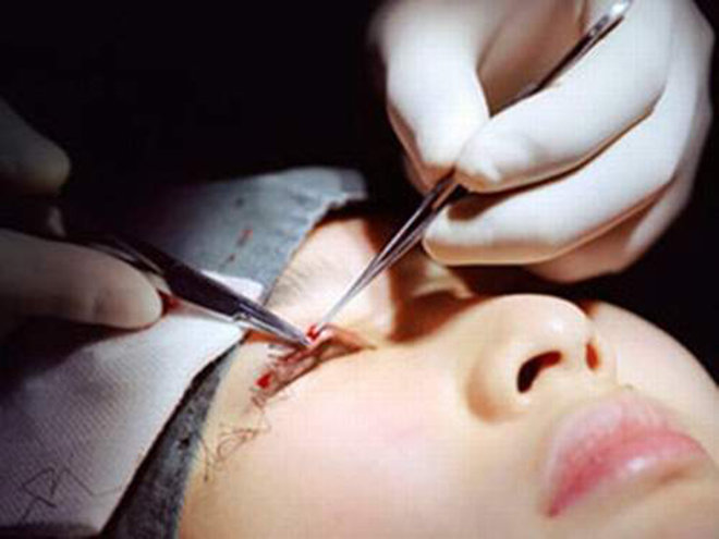 Tuy chỉ là tiểu phẫu, nhưng đừng vì thế mà xem nhẹ việc cắt mí mắt - 14
