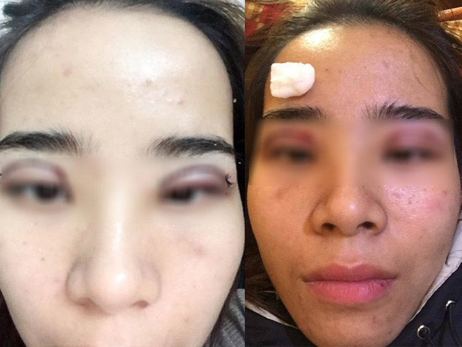 Tuy chỉ là tiểu phẫu, nhưng đừng vì thế mà xem nhẹ việc cắt mí mắt - 12