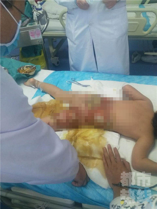 Bé gái 3 tuổi bị bỏng nặng vì xô nước nóng của cô giáo mầm non - 2