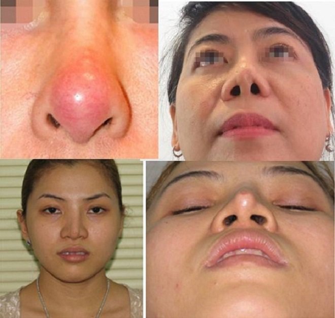Hãy tỉnh táo và thông minh trước lời mời amp;#34;nâng mũi giá rẻamp;#34; tưởng là hấp dẫn! - 5