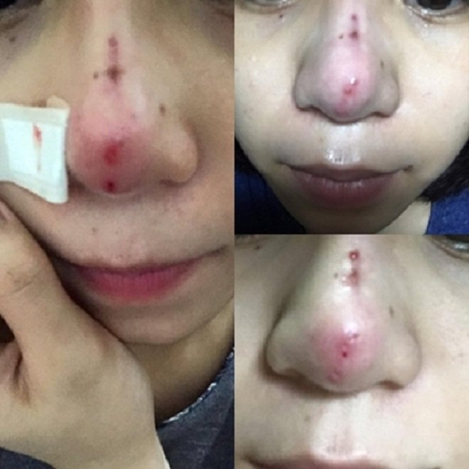 Hãy tỉnh táo và thông minh trước lời mời amp;#34;nâng mũi giá rẻamp;#34; tưởng là hấp dẫn! - 6