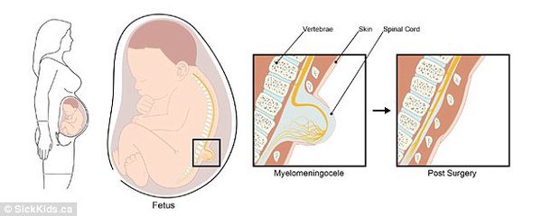 Đây là bệnh nhân nhỏ tuổi nhất thế giới, được bác sĩ phẫu thuật từ trong bụng mẹ - 2