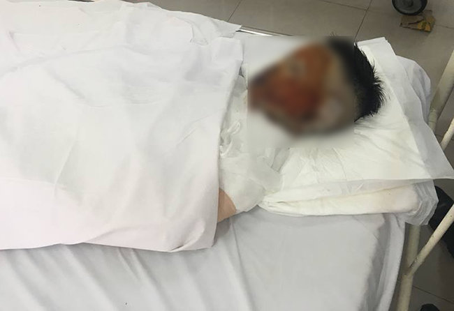 Cô gái 17 tuổi bất ngờ bị tạt axit trên đường đi làm về, nguy cơ mù 2 mắt - 1
