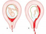 Bà bầu - Những bà bầu có nguy cơ bị vỡ tử cung - tai biến sản khoa cực kỳ nguy hiểm