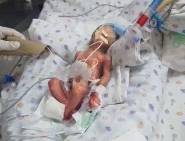 Bác sĩ thông báo bé sinh non đã tử vong nhưng người bố bất ngờ thấy con cử động - 1
