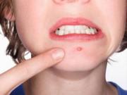 Tin tức - Chủ quan với những vết mụn trứng cá trên mặt, cô gái suýt phải trả giá bằng cả tính mạng