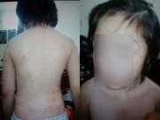 Tin tức - Tin tức 24h: Ở với bố và mẹ kế, bé trai 10 tuổi bị đánh rạn sọ não, sút 20kg