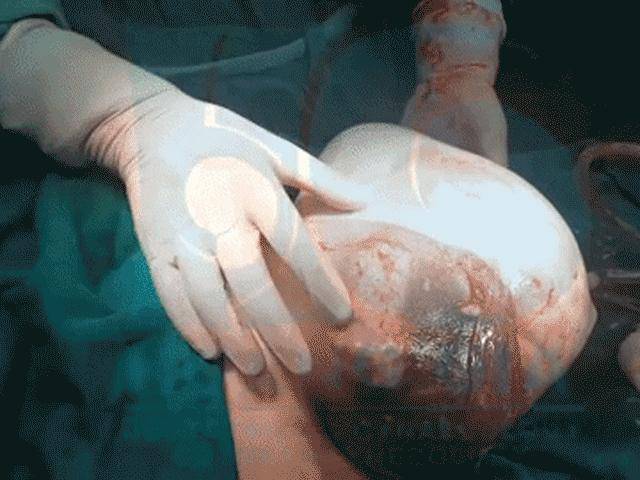 Khoảnh khắc ca sinh đôi ở TP.HCM ra khỏi bụng mẹ vẫn còn nguyên trong bọc ối