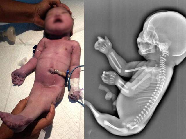 Không có tiền siêu âm, cặp vợ chồng nghèo chết lặng khi sinh ra người cá