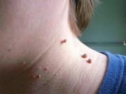 Làm đẹp - Mụn thịt cứng đầu đến đâu cũng phải rút lui với 4 cách đơn giản dưới đây