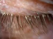 Nhà đẹp - 4 năm không giặt vỏ gối, người phụ nữ giật mình phát hiện tổ rận trăm con trên mi mắt