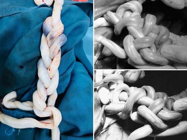 Kỳ diệu cặp song sinh ở Vĩnh Phúc chào đời với 2 dây rốn đan nhau chục vòng