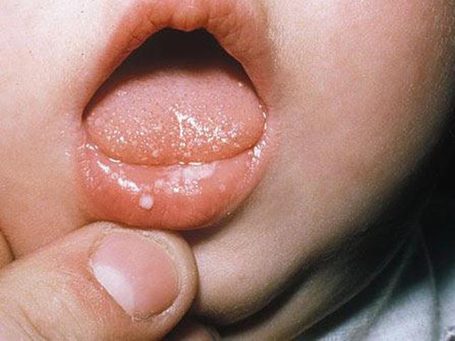 Trẻ sơ sinh bị thương và sốt phải làm sao?