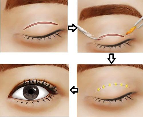 Muôn hình vạn trạng của cắt mí mắt mà chị em nào cũng nên amp;#34;nằm lòngamp;#34; thật kỹ! - 1