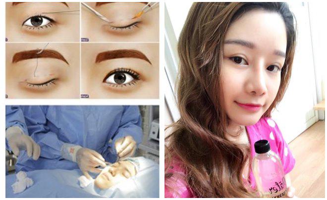 Nhật kí cắt mí mắt của cô nàng 9x từng lo sợ mắt sẽ bị amp;#34;trợnamp;#34; sau phẫu thuật! - 5