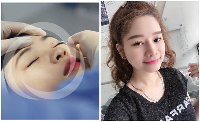 Nhật kí cắt mí mắt của cô nàng 9x từng lo sợ mắt sẽ bị amp;#34;trợnamp;#34; sau phẫu thuật! - 4