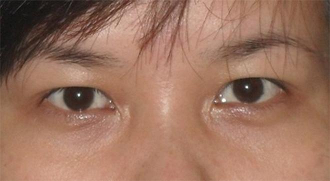 Cắt mí mắt hỏng: Do bác sĩ hãy do cách chăm sóc hậu phẫu thuật? Đâu là cách giải quyết? - 1