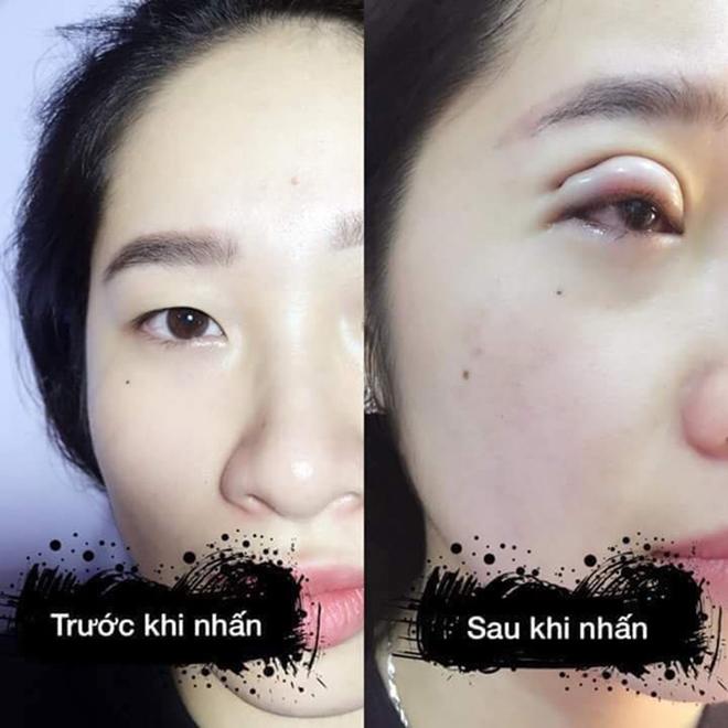 Cắt mí mắt hỏng: Do bác sĩ hãy do cách chăm sóc hậu phẫu thuật? Đâu là cách giải quyết? - 2