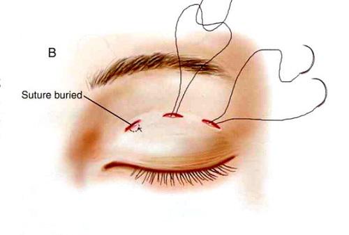 Muôn hình vạn trạng của cắt mí mắt mà chị em nào cũng nên amp;#34;nằm lòngamp;#34; thật kỹ! - 6
