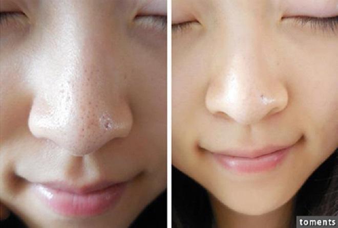 Có 8 chiêu này, mụn đầu đen chỉ còn là chuyện nhỏ! - 2