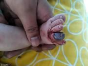 Tin tức - Bé trai 2 tháng tuổi đau đớn khi ngón chân bị hoại tử chỉ vì một sợi tóc rụng