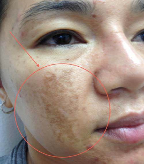 Ghi ngay vào sổ tay những cách trị nám, tàn nhang với công thức cực độc tại nhà! - 8