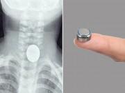 Làm mẹ - Bé 2 tuổi suýt tử vong vì nuốt phải cục pin rất phổ biến trong đồ chơi trẻ em