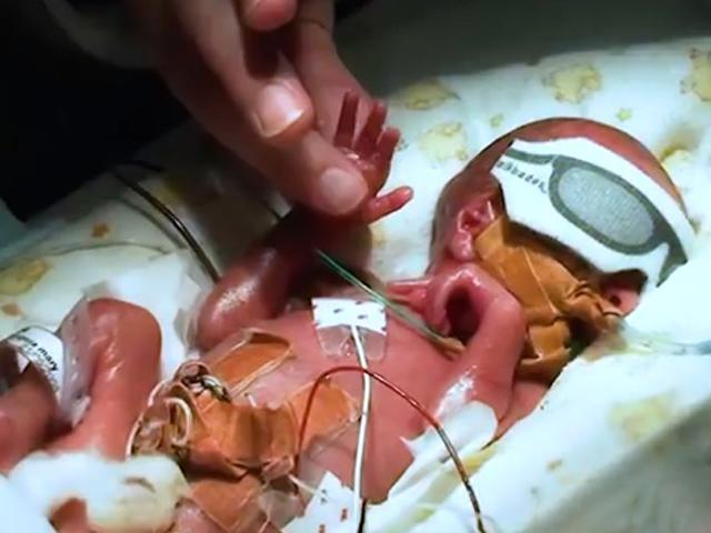 Kỳ tích sống sót của Toby bé nhỏ sinh non ở tuần 24 khiến cả thế giới khâm phục