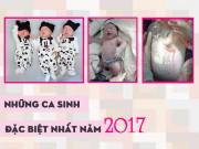 Bà bầu - Những ca sinh đặc biệt, thế giới cũng hiếm gặp nhưng đã xảy ra ở Việt Nam năm 2017