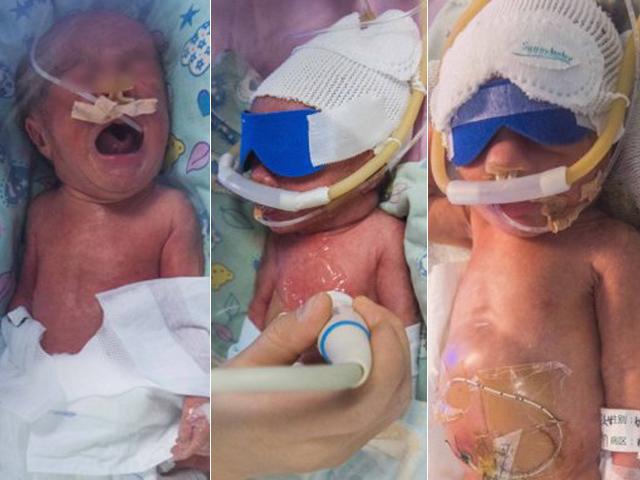 Ca sinh ba hy hữu: 1 bé sinh thường hôm trước, 2 bé đẻ mổ hai ngày sau