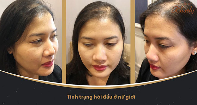 Giải pháp “cấp cứu” hiệu quả cho mái tóc thưa, mỏng của chị em - 1