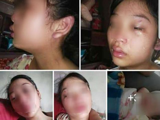 Mới sinh con hơn 1 tháng, vợ 16 tuổi lên mạng xã hội tố bị chồng bạo hành