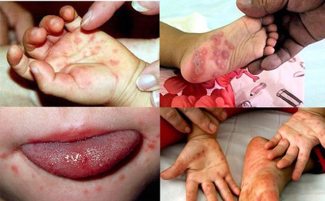 Trẻ mắc chân tay miệng ngày càng nặng có thể do phạm phải những sai lầm này - 2