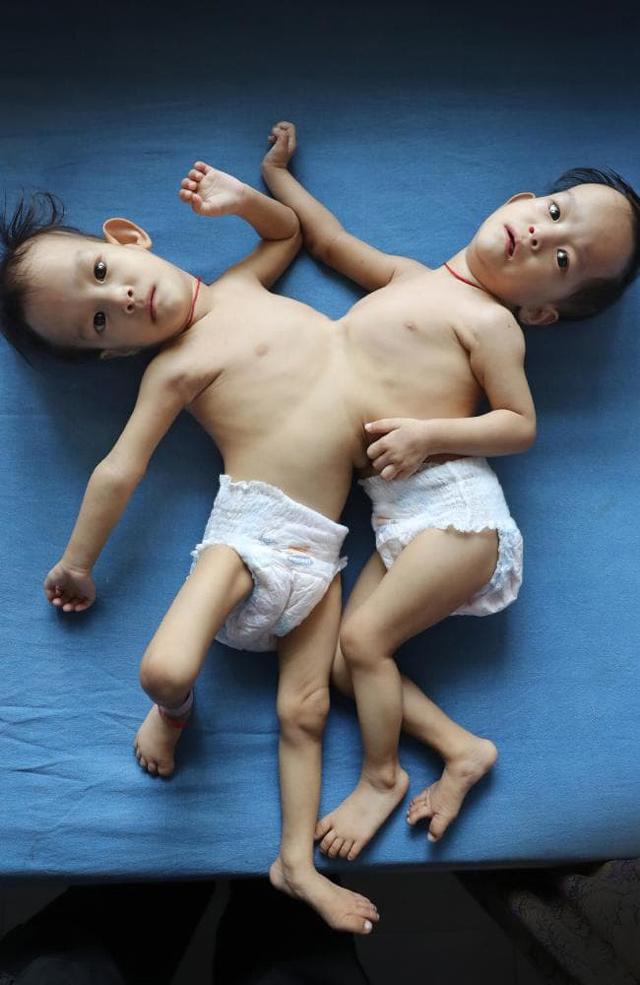Mẹ đau đớn chấp nhận phẫu thuật cho cặp song sinh dính liền dù có nguy cơ mất 1 đứa - 1