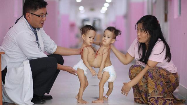 Mẹ đau đớn chấp nhận phẫu thuật cho cặp song sinh dính liền dù có nguy cơ mất 1 đứa - 2