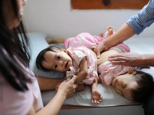 Mẹ đau đớn chấp nhận phẫu thuật cho cặp song sinh dính liền dù có nguy cơ mất 1 đứa - 4