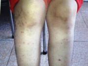 Sức khỏe - Tưởng nổi mụn bình thường, cô gái không ngờ mắc bệnh hiếm đã lan vào cả phổi