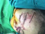 Bé 31 tháng tuổi bị chó nhà cắn nhiều nhát vào mặt, phải nhập viện cấp cứu