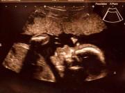 Bà bầu - Đang nằm viện điều trị ung thư, ông bố trẻ sững người khi thấy vợ bỗng dưng có bầu