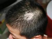 Sức khỏe - Con trai 3 tuổi đột nhiên bị rụng tóc, nguyên nhân thật sự khiến cha mẹ rất xấu hổ