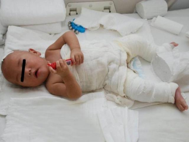 Cậu bé bị bỏng nước sôi 100 độ, hành động sơ cứu của người mẹ ai cũng nên học hỏi