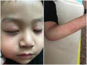 Sức khỏe - Con bị dị ứng trứng, mẹ không cho ăn nhưng hành động của con lại vô tình gây phát bệnh