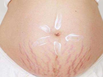 Rạn da đến mấy cũng mờ đi với công thức thần kỳ từ viên Vitamin E và nha đam